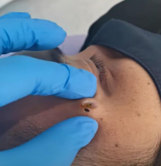 Blackheads Pimple Popper on Face 261