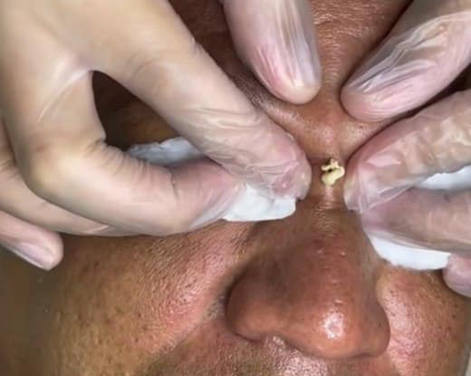 Blackheads Pimple Popper on Face 274