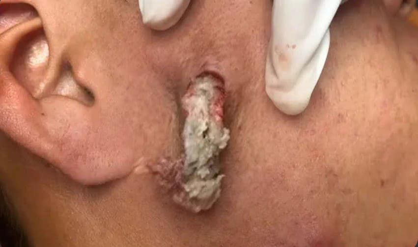 Blackheads Pimple Popper on Face 248