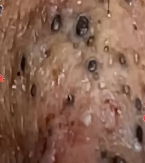 Blackheads Pimple Popper on Face 266