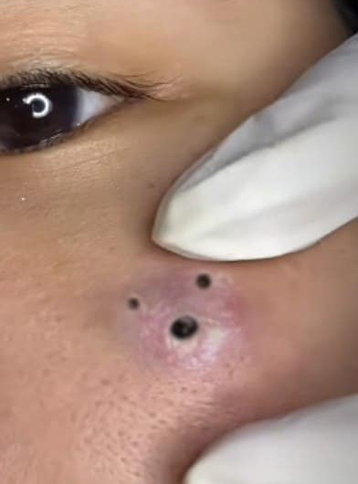 Blackheads Pimple Popper on Face 275