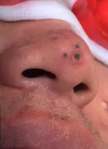 Blackheads Pimple Popper on Face 303