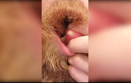 Blackheads Pimple Popper on Face 278