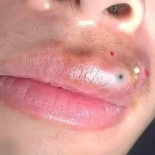 Blackheads Pimple Popper on Face 271