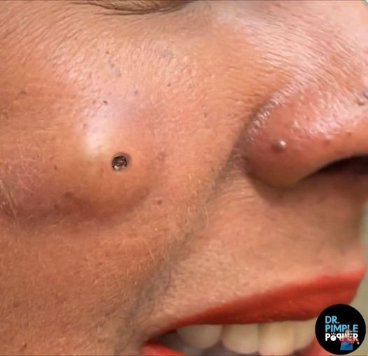 Blackheads Pimple Popper on Face 288