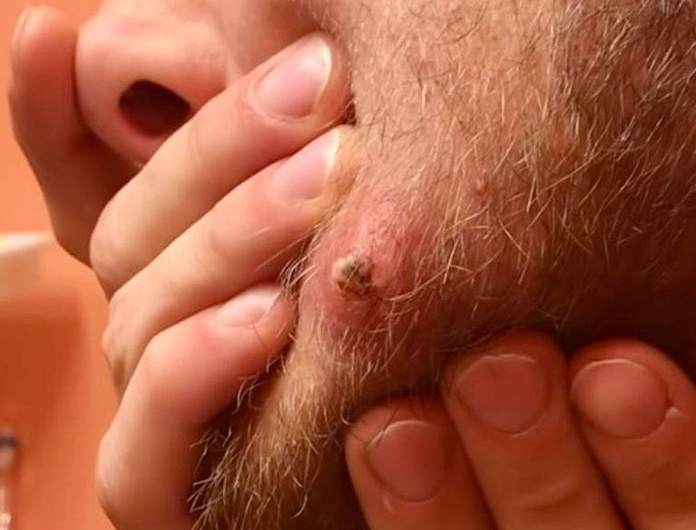 Blackheads Pimple Popper on Face 254