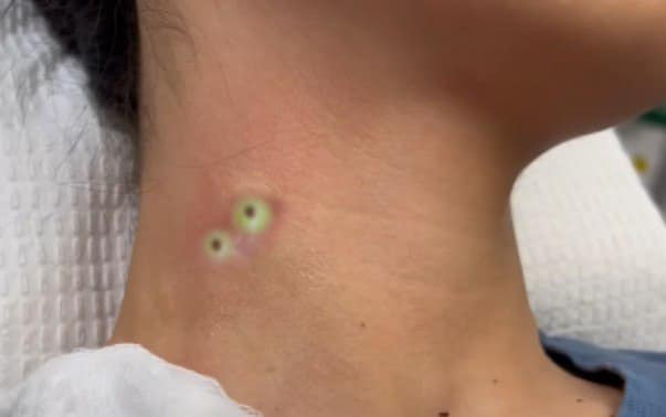 Blackheads Pimple Popper on Face 272