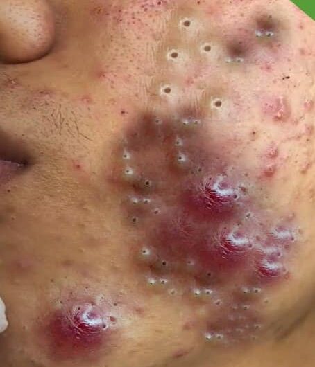 Blackheads Pimple Popper on Face 291