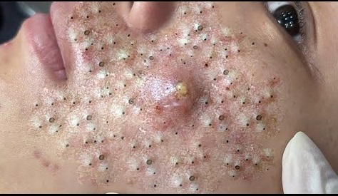 Blackheads Pimple Popper on Face 256