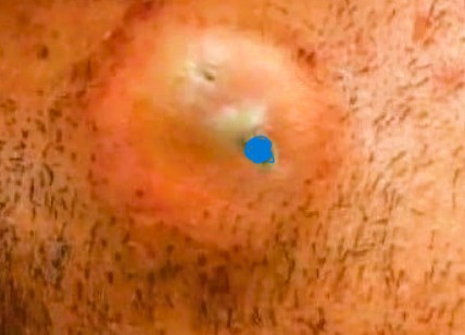 Blackheads Pimple Popper on Face 310