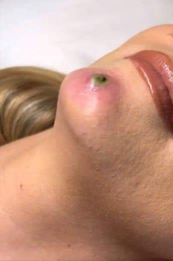 Blackheads Pimple Popper on Face 336