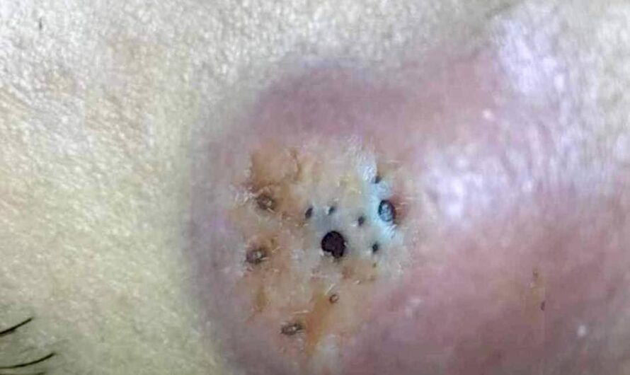 Blackheads Pimple Popper on Face 359