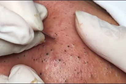 Blackheads Pimple Popper on Face 360